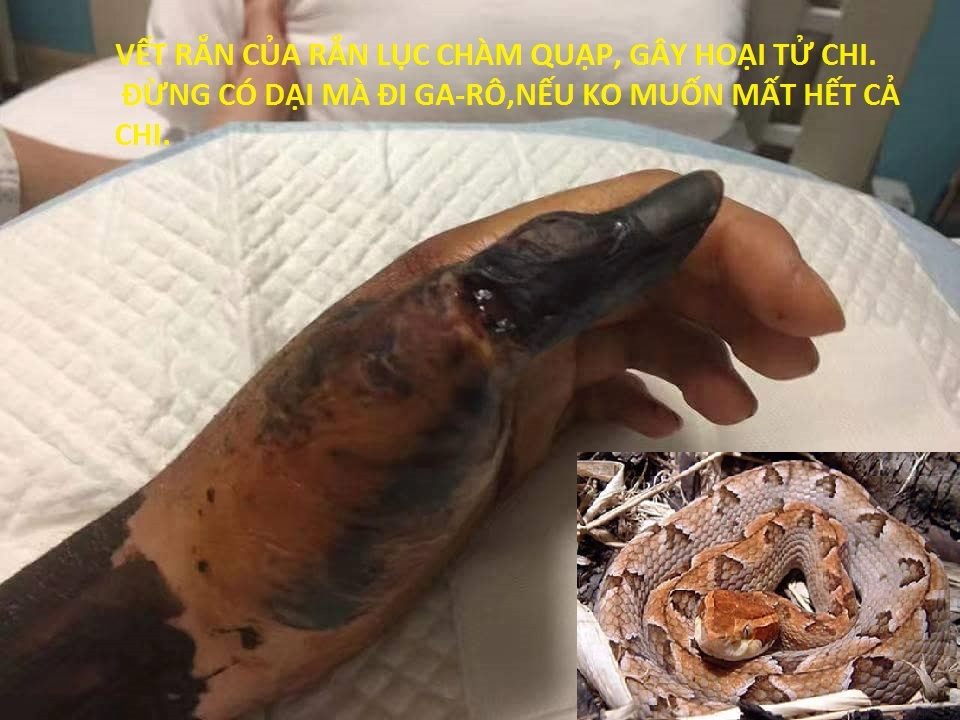 vết cắn rắn chàm quạp