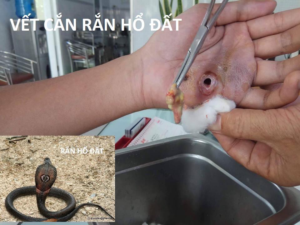 Vết Cắn Rắn Hổ Đất