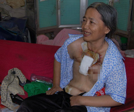 ung-thu-xuyen-V.jpg