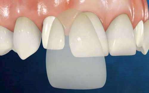 dán răng sứ veneer,dán răng sứ veneer là gì,miếng dán răng sứ veneer,có nên dán răng sứ veneer,dán răng sứ veneer có tốt không,răng sứ veneer có tốt không,răng sứ veneer là gì,dán răng sứ
